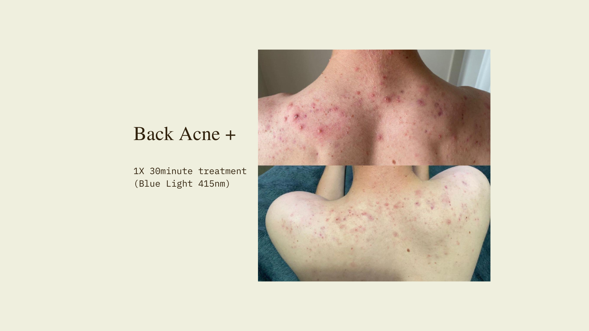 LED Facial Therapy Before and After - Back Acne