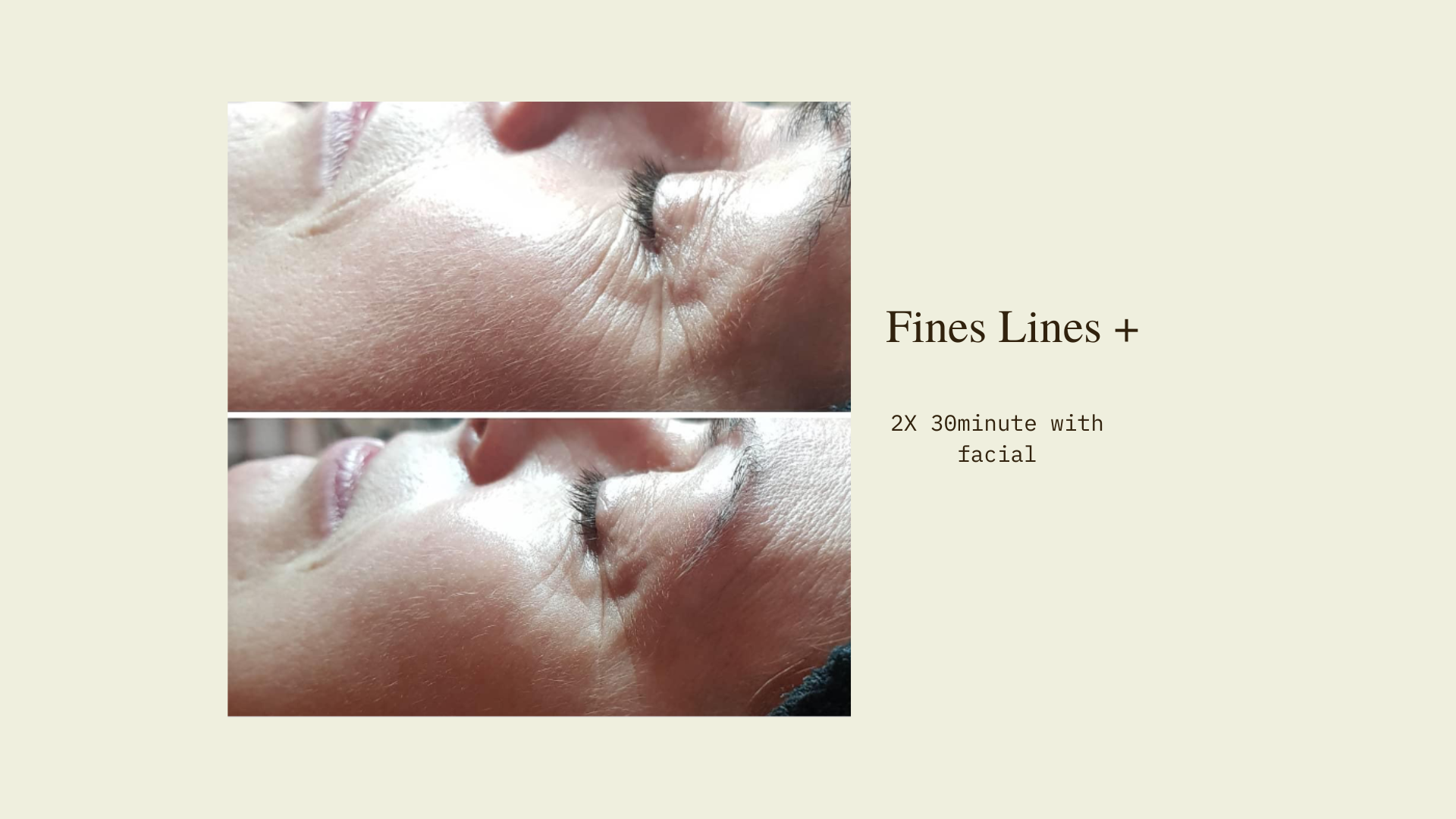 LED Facial Therapy Before and After results on Fine Lines