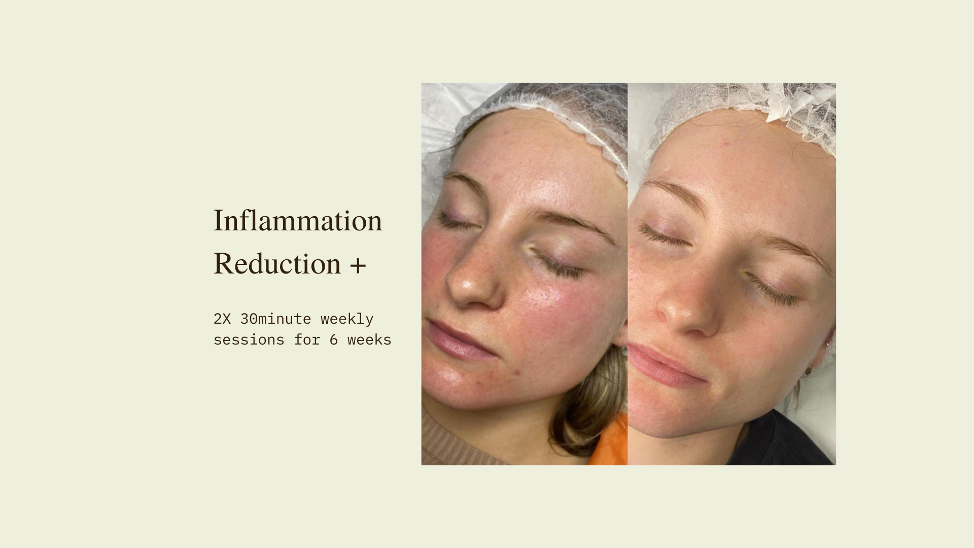 LED facial Therapy Before and After- Inflammation Reduction