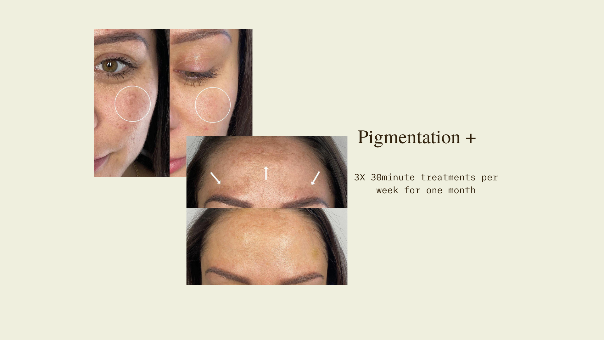 LED Facial Therapy Before and After- Pigmentation
